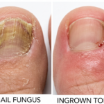 Ingrown Toenails :The Pain Nobody Talks About (And What You Can Do)